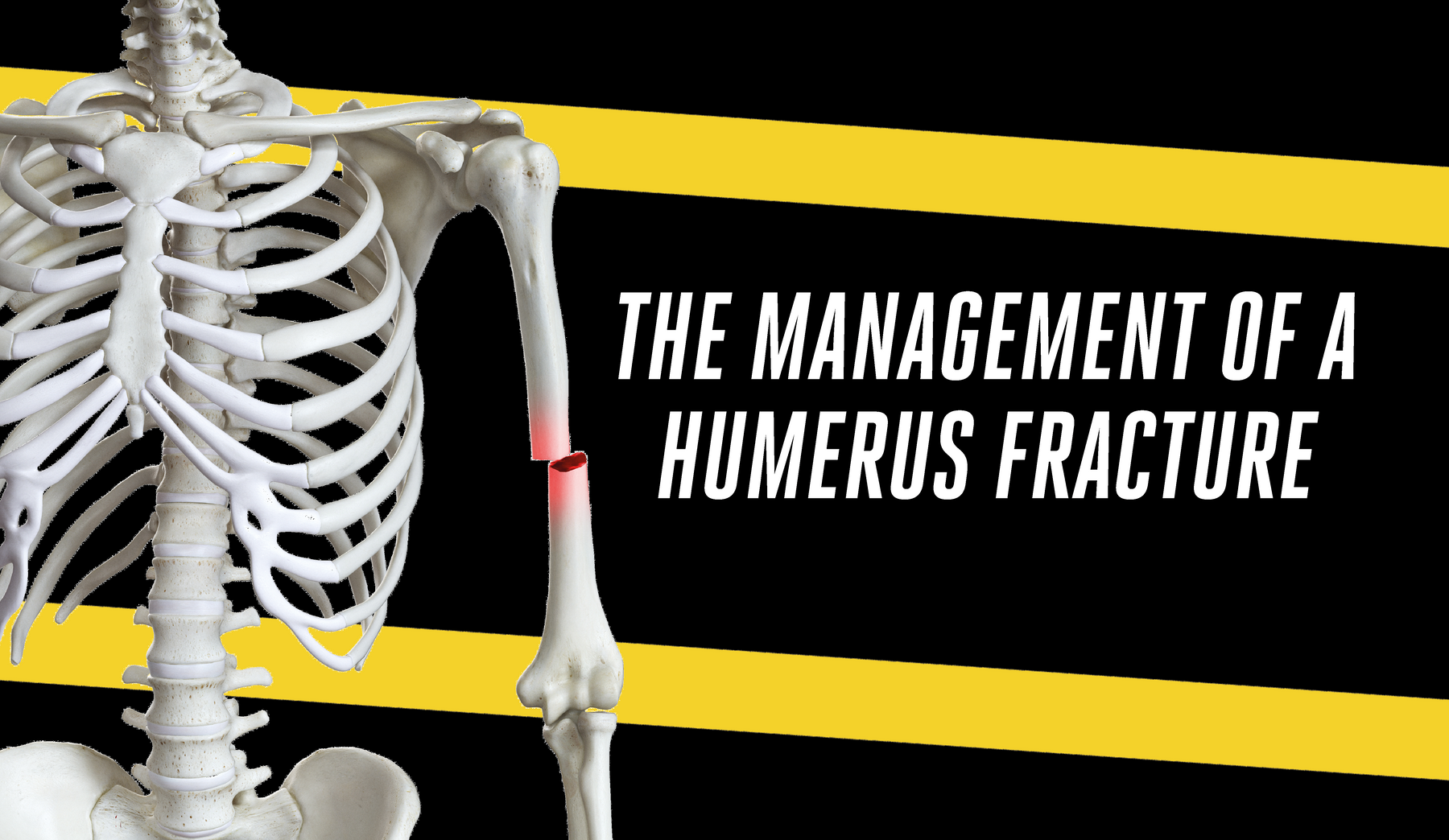 The Management of a Humerus Fracture