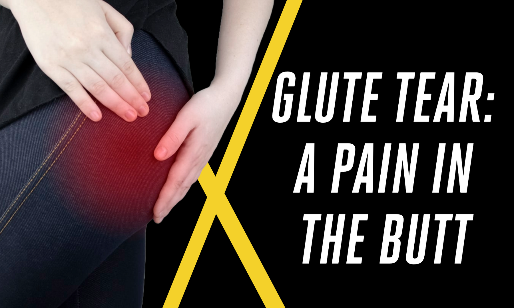 Glute Tear: A Pain In The Butt